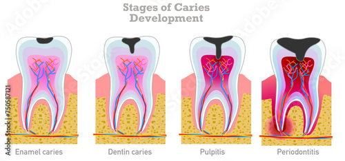 Caries stages development. Tooth decay enamel, dentin caries, pulpitis, periodontitis chart. Medical , dental pain. Illustration vector