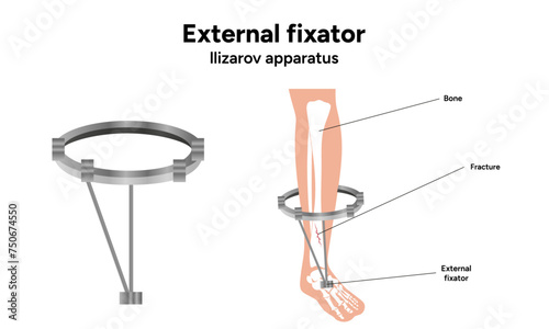 External fixator, llizarov apparatus with leg