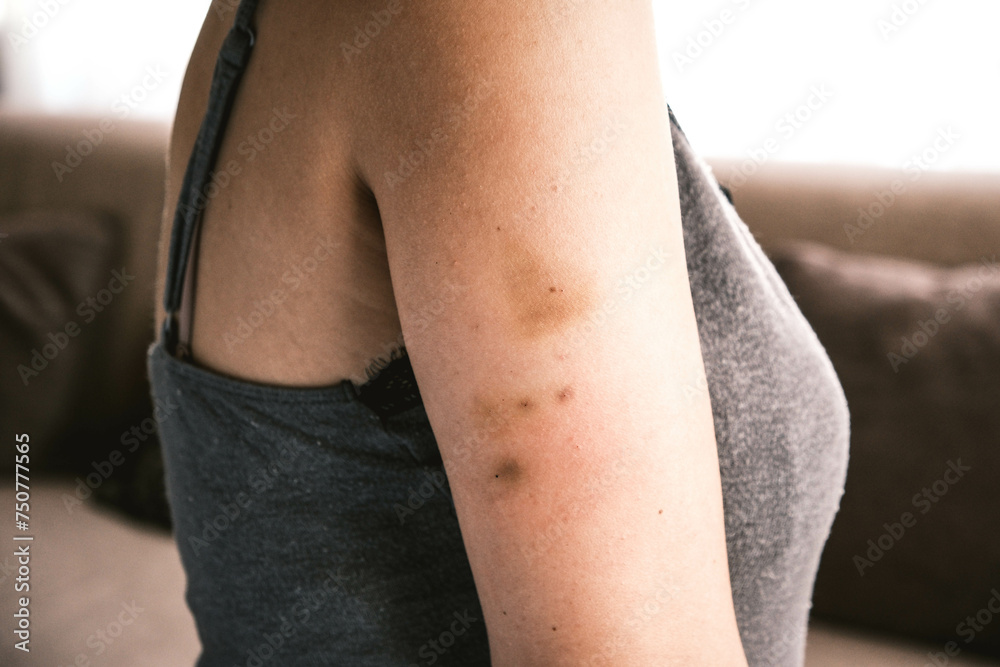 Zdjęcie Stock Bruising on the arm caused by previous injections. Blood
