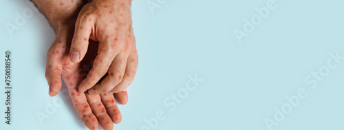 Human Hands with Painful Rash, Red Spots Blisters on the Skin. Health Problem. Monkeypox Disease Symptoms. Male Patient Arms with Monkey Pox. Close Up. Banner, Copy Space. Dengue Fever Infection, MPOX photo