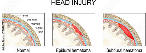 Epidural hematoma and Subdural hematoma. Traumatic brain injury photo