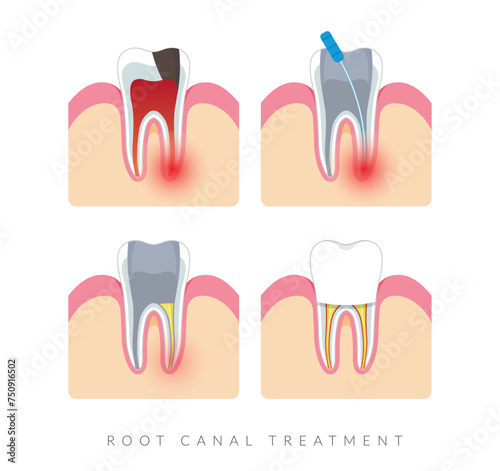 Dental Procedure - Root Canal Treatment - Stock Illustration