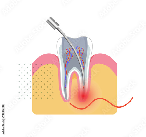 Dental Procedure - Root Canal Treatment - Stock Illustration