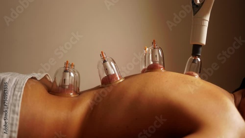 Woman getting cup therapy at spa. Chinese vacuum suction treatment for pain relief photo
