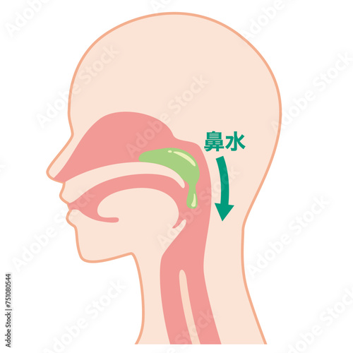 後鼻漏
