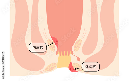 肛門の病気、痔・いぼ痔　図解イラスト、断面図