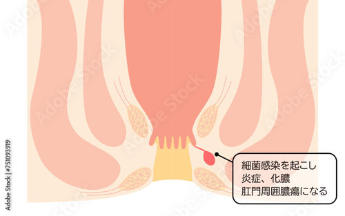 肛門の病気、痔「あな痔（痔ろう）」　図解イラスト、断面図 photo