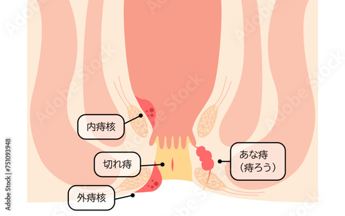 肛門の病気、痔・いぼ痔・切れ痔・あな痔　図解イラスト、断面図
