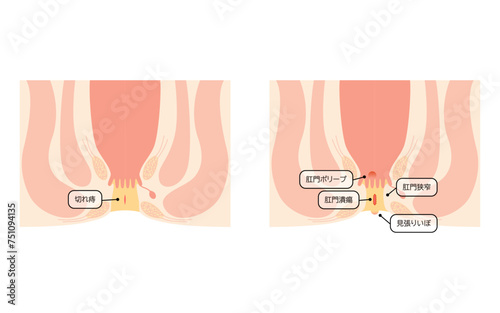 肛門の病気、痔「切れ痔、肛門潰瘍、肛門狭窄、肛門ポリープ」　図解イラスト、断面図