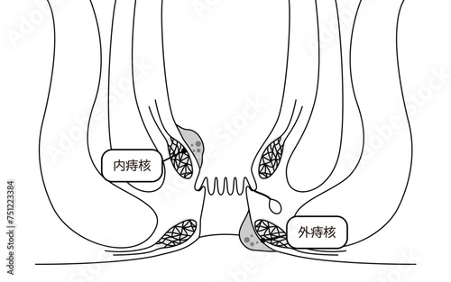 肛門の病気、痔・いぼ痔　図解イラスト、断面図