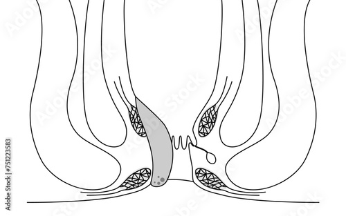 肛門の病気、痔・いぼ痔「内痔核Ⅱ度」　図解イラスト、断面図