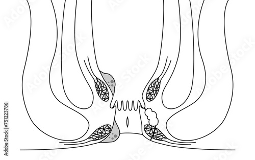 肛門の病気、痔・いぼ痔・切れ痔・あな痔　図解イラスト、断面図