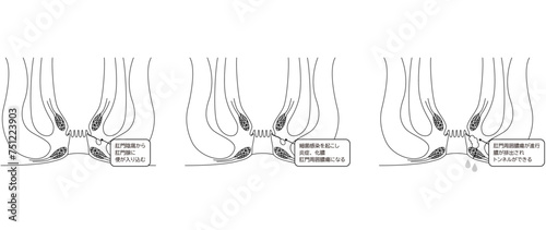 肛門の病気、痔「あな痔（痔ろう）」　図解イラスト、断面図