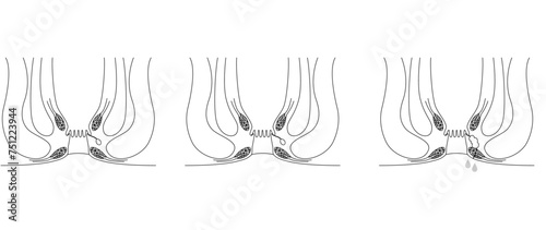 肛門の病気、痔「あな痔（痔ろう）」　図解イラスト、断面図