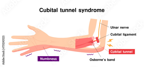 Cubital tunnel syndrome vector illustration photo