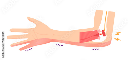 Cubital tunnel syndrome vector illustration