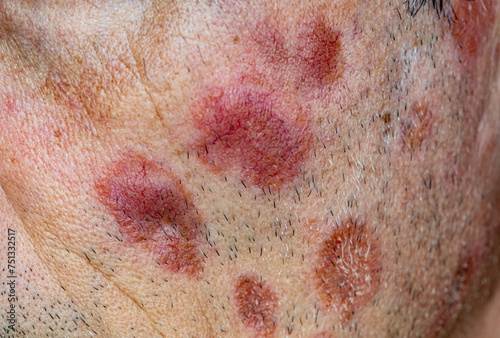 A case of cutaneous sarcoidosis on the face of a man, close up view photo