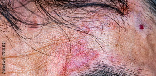 A case of cutaneous sarcoidosis on the face of a man, close up view photo