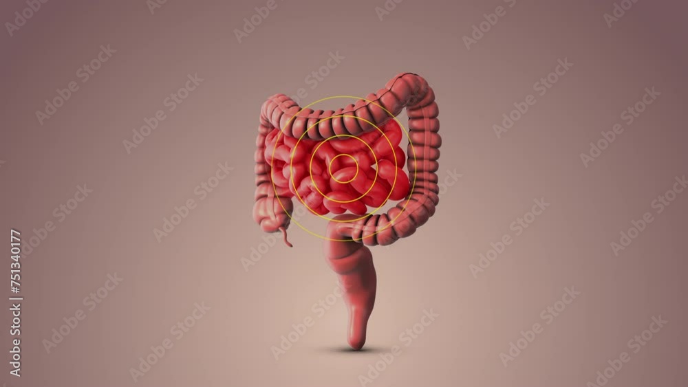 Irritable bowel syndrome medical animation