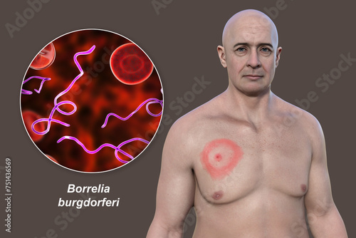 A man with erythema migrans, a characteristic rash of Lyme disease caused by Borrelia burgdorferi, 3D illustration photo