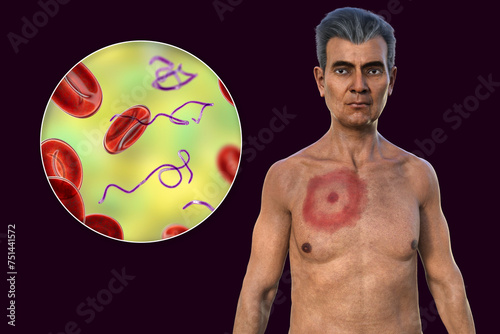 A man with erythema migrans, a characteristic rash of Lyme disease caused by Borrelia burgdorferi, 3D illustration
