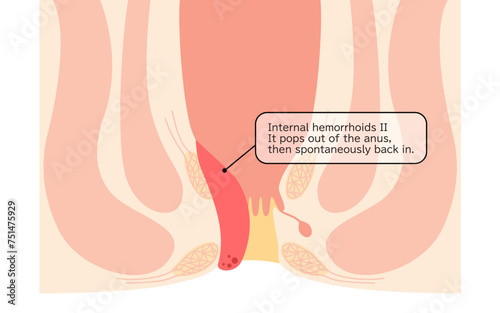 Diseases of the anus, hemorrhoids and warts "Internal hemorrhoids, degree II" Illustration, cross-sectional view