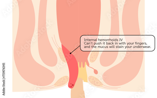 Diseases of the anus, hemorrhoids and warts "Internal hemorrhoids, degree IV" Illustration, cross-sectional view