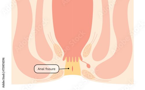 Diseases of the anus, hemorrhoids "anal fissures" Illustration, cross-sectional view