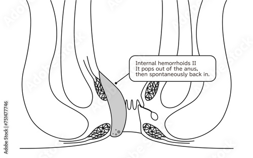 Diseases of the anus, hemorrhoids and warts "Internal hemorrhoids, degree II" Illustration, cross-sectional view