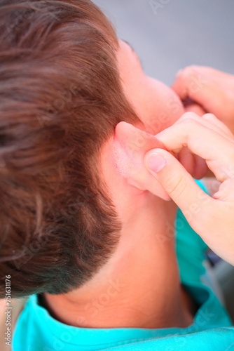 Painful flaking and itching of skin behind ears of young boy