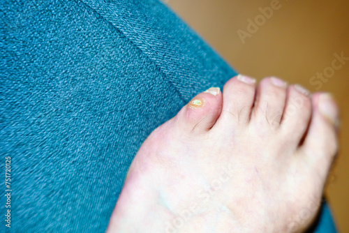Old dry callus on the little toe photo