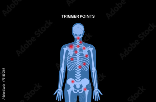 Myofascial trigger points