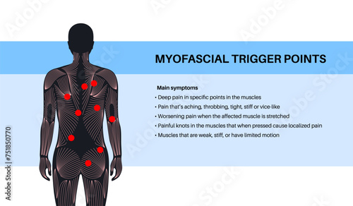 Myofascial trigger points