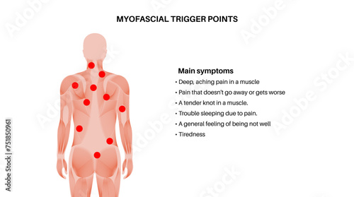 Myofascial trigger points