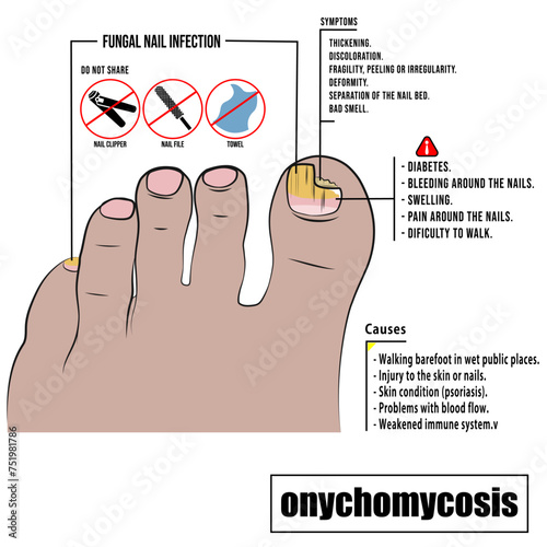 Onychomycosis, fungal infection of the nail plate. Toenail fungus.