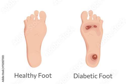 Diabetic and healthy feet vector illustration. photo