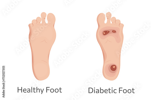 Diabetic and healthy feet vector illustration.