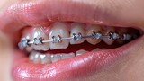 Close up shot on a beautiful mouth with orthodontic braces
