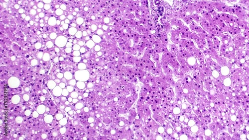 Hepatic steatosis, light micrograph footage revealing fat accumulation in liver cells, known as fatty liver disease.
