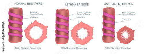 Bronchial asthmatic symptoms. Bronchitis is an inflammation of the bronchial tubes, which are the air passages that carry air to the lungs. It can be either acute or chronic vector illustration