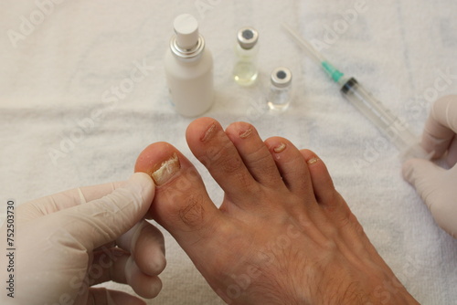 dermatologist examining patient with toenail fungus. A doctor examines bare foot with onycholysis on a toenail after damaging with tight shoes or using gel-lacquer. photo
