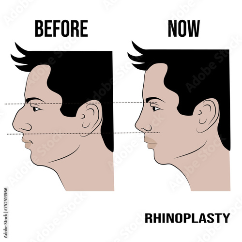Rhinoplasty, a surgical intervention, mainly resolves the aesthetic problems of the nose.