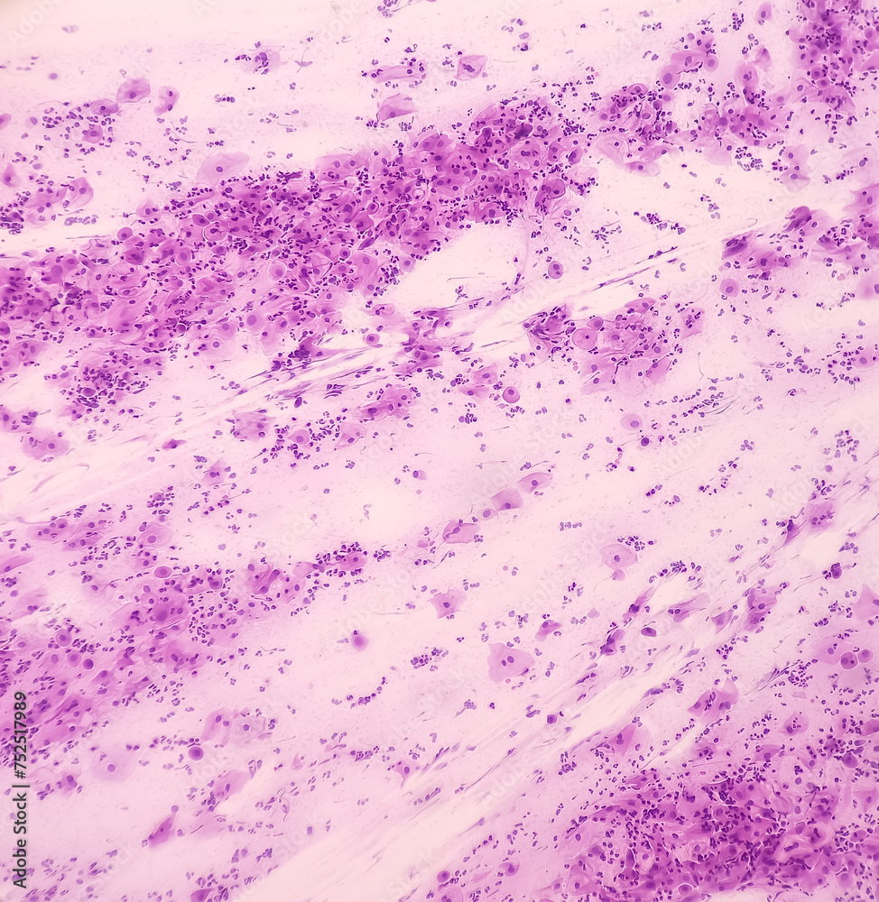 Cervical cancer cells. Atypical squamous cells of undetermined significance(ASCUS), Cancer of cervix, Pap's smear, pap's. Cervical cancer cells. Atypical squamous cells of undetermined significance(ASCUS), Cancer of cervix, Pap's smear, pap's.