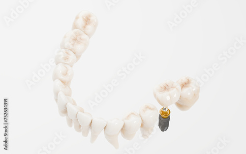 Dental Implant 3D photo