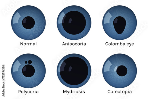 Eye pupils set with disease vector illustration.