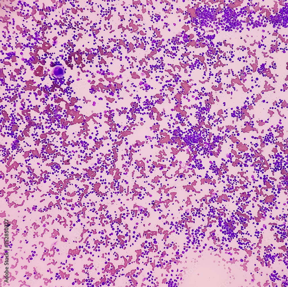 Blood cancer. Photomicrograph of Acute Myeloblastic Leukemia or AML, a ...