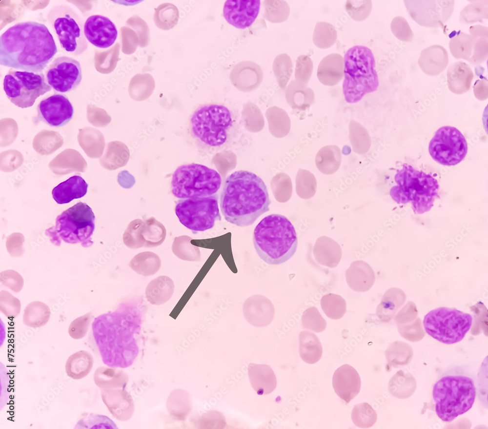 Blood cancer. Photomicrograph of Acute Myeloblastic Leukemia or AML, a ...