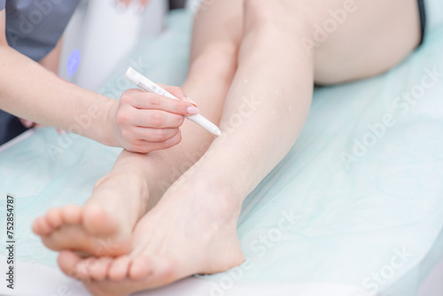 Laser hair removal specialist paints over moles on the leg of an elderly woman with a white marker before laser hair removal