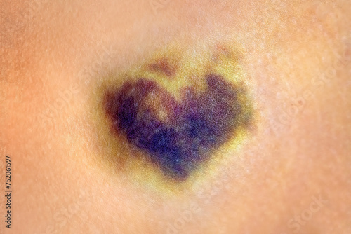 Bruise in shape of heart