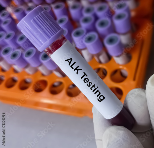 Blood sample for ALK (Anaplastic Lymphoma Kinase) gene test, ALK mutation analysis. photo